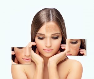 dark-spots-freckles-hyperpigmentation-melasma-chloasma-concept-skin-lightening-scaled